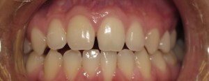 Before - Porcelain Veneers on top teeth