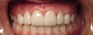 After - Porcelain Veneers on top teeth