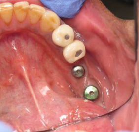  Replacement of two missing teeth with Implants