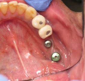 Replacement of two missing teeth with Implants