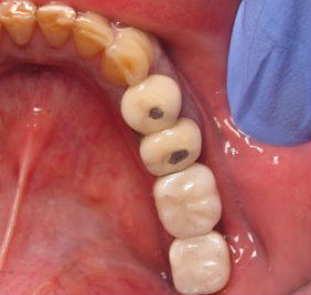 Crowns on Implants