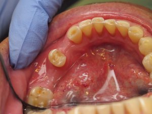 Two Implants for Missing teeth