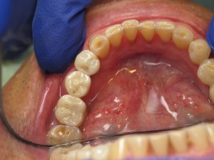 Crowns on Implants and a natural tooth