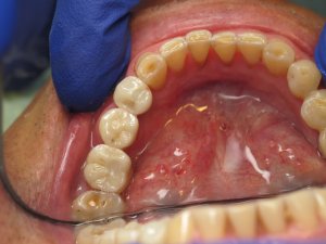 Crowns on Implants and a natural tooth
