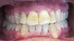After Invisalign and Whitening