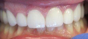 After - Porcelain Veneers on top teeth