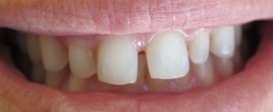 Before - Porcelain Veneers on top teeth