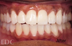 After Orthodontics - Adjusted gap