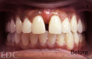 Before Orthodontics - Gap in front top teeth