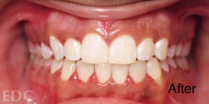 After Orthodontics - Crowding and an Overbite