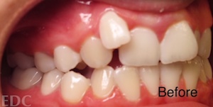 Before Orthodontics - Crowding
