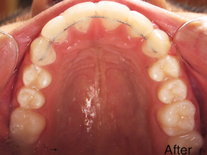 After Orthodontics - Adjusted crowding with view of under top teeth