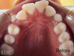 Before Orthodontics - Crowding with view of under top teeth