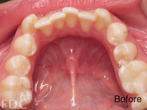 Before Orthodontics - Crowding with top view of lower teeth