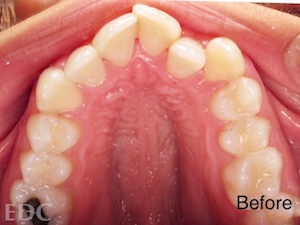 Before Orthodontics - Crowding with view of under top teeth