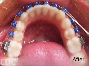 After Orthodontics - Adjusted crowding with top view of lower teeth with braces and rubber bands