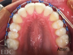 After Orthodontics - Adjusted crowding with view of under top teeth with braces and rubber bands