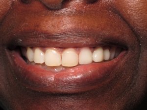 smile showing Crowns on Implants for restoration of smile