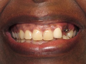 smile showing Replacement of two missing teeth