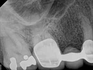 xrat that shows Replacement of failing Bridge with Implant