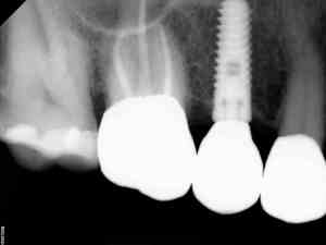 xray that shows Replacement of failing Bridge with Implant