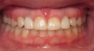 mouth showing Replacement of Missing Teeth with Implants and Porcelain Crowns