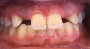 smile showing Congenitally Missing Teeth