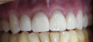 Restoration of discolored, broken, and chipped teeth with porcelain crowns