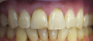 Restoration of discolored, broken, and chipped teeth