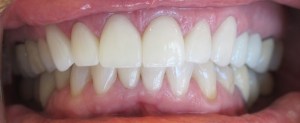 After - Porcelain Crowns 