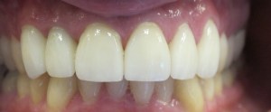 After - Porcelain Crowns 