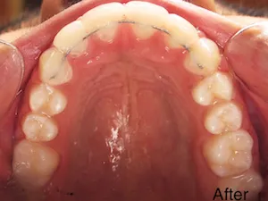 mouth showing After Orthodontics - Adjusted crowding with view of under top teeth