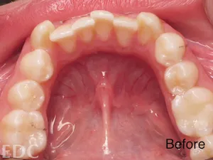 mouth showing Before Orthodontics - Crowding with top view of lower teeth