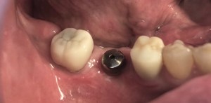 mouth showing Replacement of one missing tooth