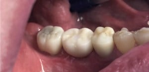 mouth showing Crown on Single Implant