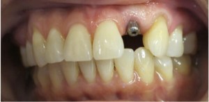 mouth showing Replacement of one missing tooth with an Implant on Upper Tooth