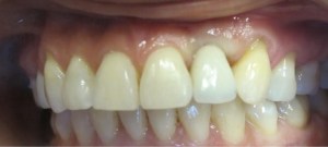 mouth showing Crown on dental implant of one missing tooth on Upper Tooth