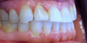 Before - Side View of Porcelain Veneers on top teeth