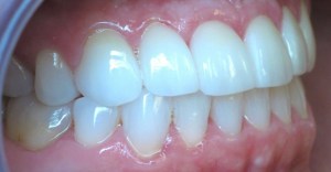 After - Side View of Porcelain Veneers on top teeth