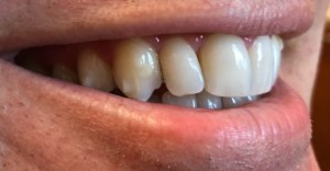Before - Side View of Porcelain Veneers on top teeth