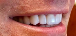 After - Side View of Porcelain Veneers on top teeth