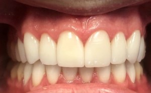 After - Porcelain Veneers on top teeth