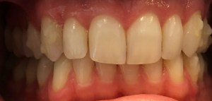 Before - Porcelain Veneers on top teeth