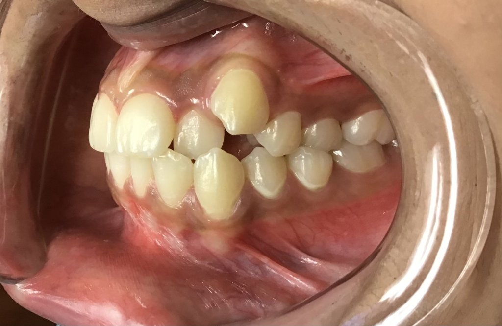 smile Before Orthodontics