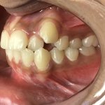 smile Before Orthodontics