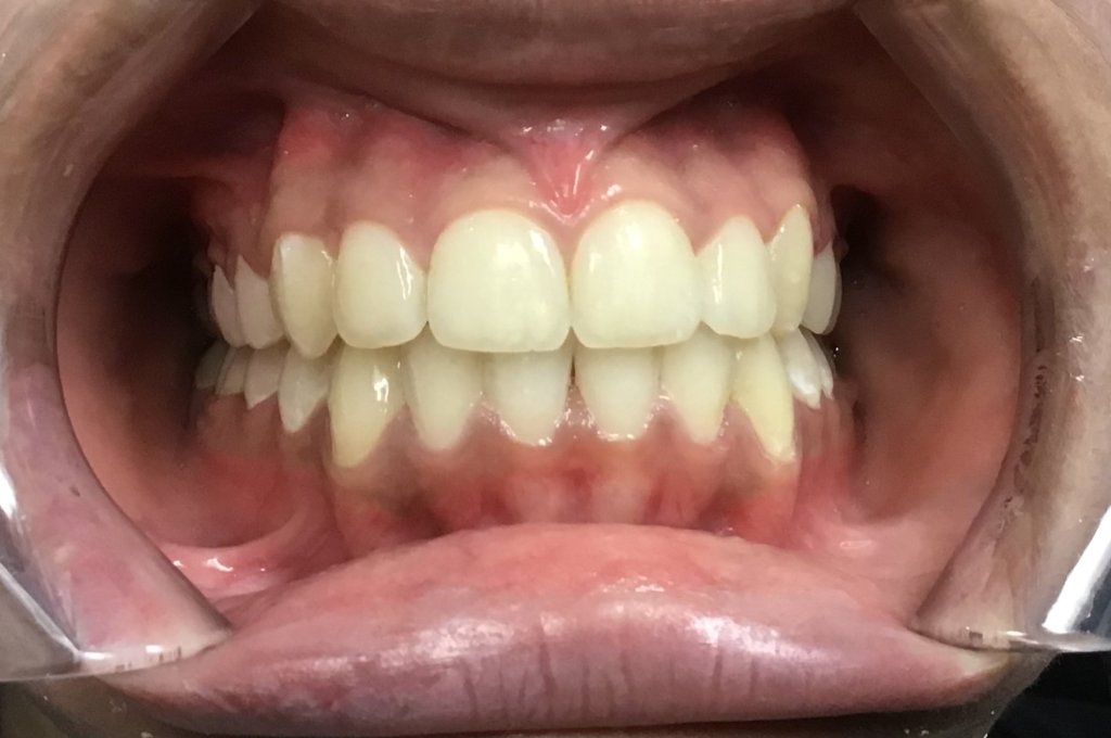 After Orthodontics