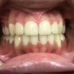 After Orthodontics