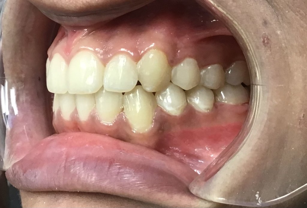 After Orthodontics