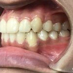 After Orthodontics