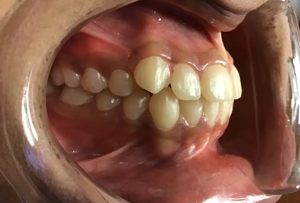 smile Before Orthodontics